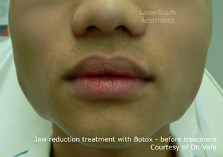 jaw reduction with Botox results before midtown